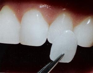 Photo: placage sur les dents de devant