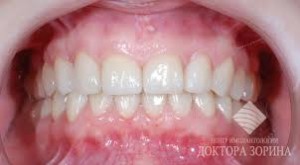 Foto: dents després d’instal·lar xapes