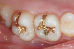 Photo: tampons à dents en or