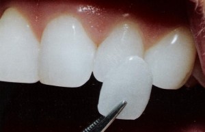 Foto: pripevnenie dyhy na zubnú korunku