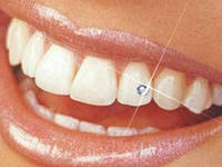 Photo: superposition décorative pour les dents