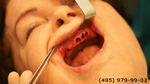 Photo: avant les implants dentaires