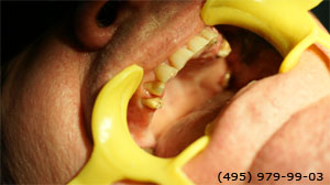 Photo: avant les implants dentaires