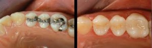 Photo: types de languettes dentaires