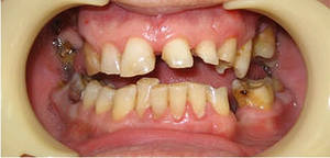 Photo: dents avant prothèses