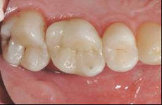 Photo: les languettes dentaires ressemblent à ceci