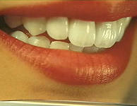 Photo: La similitude des dents en céramique sans métal avec les vraies