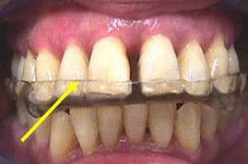 Photo: Traitement du grincement des dents