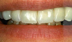 Photo: Esthétique des dents lors de la restauration par onglets