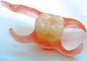 Photo: prothèse papillon amovible à une dent