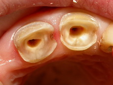 Photo: Préparation des dents sous l'onglet