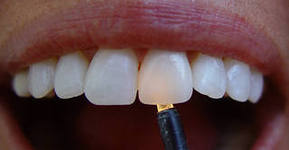 Photo: La ressemblance avec de vraies dents