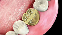Photo: couronne d'or sur la dent