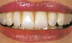 Photo: dents après l'installation d'une prothèse amovible