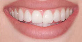 Photo: Voici à quoi ressemblent les lumineers sur leurs dents