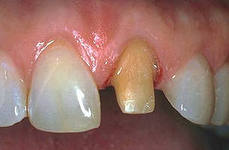Photo: préparation d'une dent sous une couronne