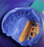 Photo: Moulages dentaires pour la fabrication de couronnes