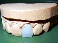 Photo: moulage des dents