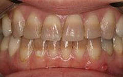 Photo: Dents de tétracycline