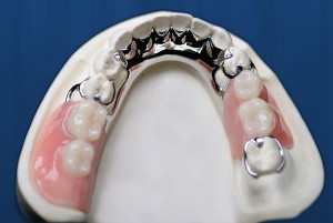 Photo: Clasp prosthesis on the lower jaw