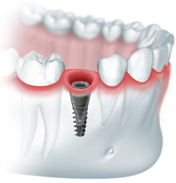 Foto: Installert implantat