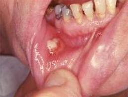 Foto: O processo inflamatório da mucosa oral
