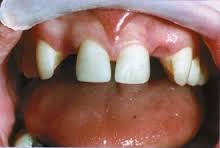 Foto: Defeitos na dentição