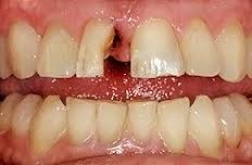 Foto: letsel van de tand en het subgingivale deel ervan