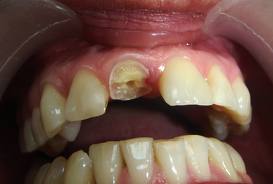 Foto: Zwaar beschadigde tand