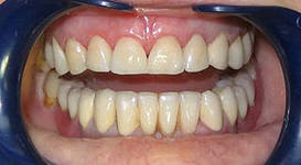 Zähne nach der Prothese
