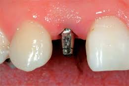 Photo: implant installé après extraction dentaire