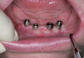 Foto: Implantatie bij afwezigheid van meerdere tanden