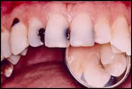 الصورة: الأسنان المتضررة من تسوس الأسنان
