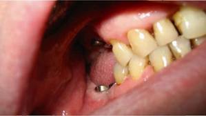 Foto: Gezonde tanden hebben in de buurt van het implantaat