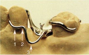 Foto: Elementos básicos de um fecho de fio de braço único