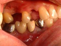 Photo: Lack of premolars