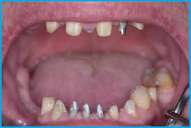 Kuva: Valmistetut hampaat