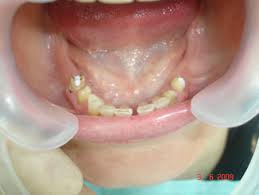 Foto: falta parcial de dentes