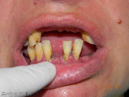 Foto: Förekomsten av defekter i tandvården, tänderna lossnar