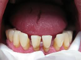 Foto: Exposición de las raíces de los dientes.