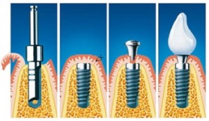Foto: Stadia van implantaatplaatsing