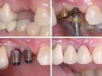 Photo: étapes d'implantation dentaire