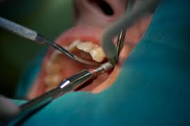 Foto: tandheelkundige implantatie