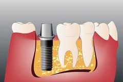 Photo: prothèses ARDS avec implants