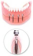 Foto: Prothetiek op mini-implantaten