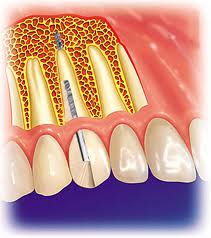 Foto: Endodonto - endossal implantasjon