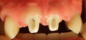 Ảnh: Abutment zirconium