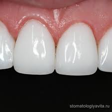 Photo: céramique sur les dents de devant