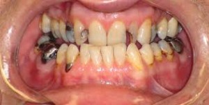 Photo: plusieurs défauts dentaires