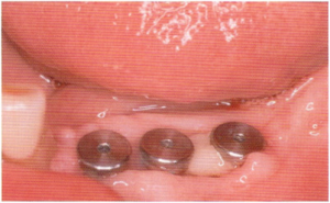 Nuotrauka: trijų implantų ekspozicija